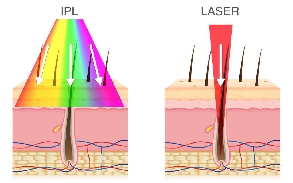 Ipl Vs Laser
